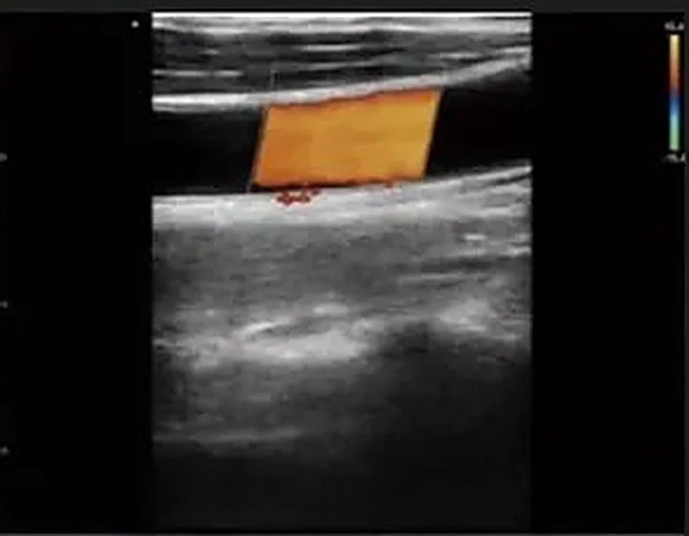 Vaso em corte com Doppler no app RC Medical