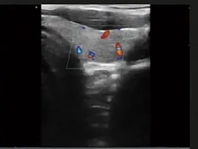 Estruturas superficiais com Doppler colorido no app RC Medical